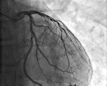 An image of the heart obtained by angiography.