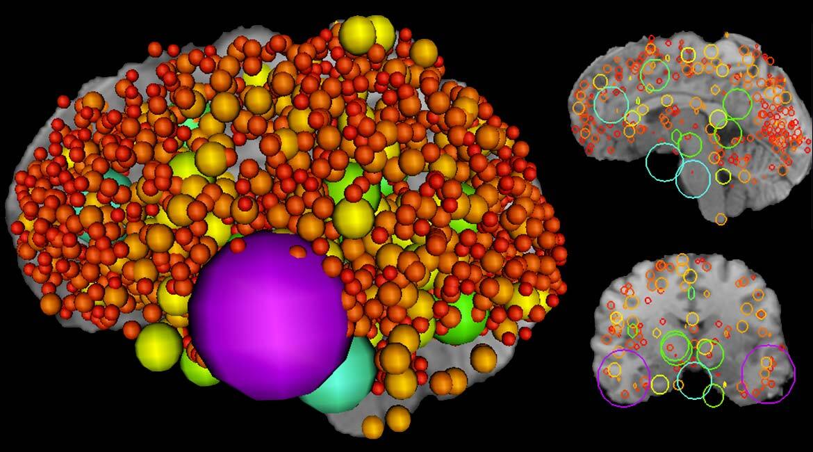 Information Particles in a 3D brain MRI image