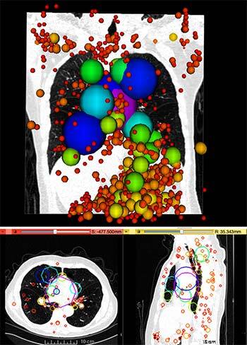 Information Particles in a 3D lung CT image