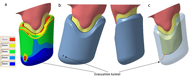 3D view of prosthetic crown