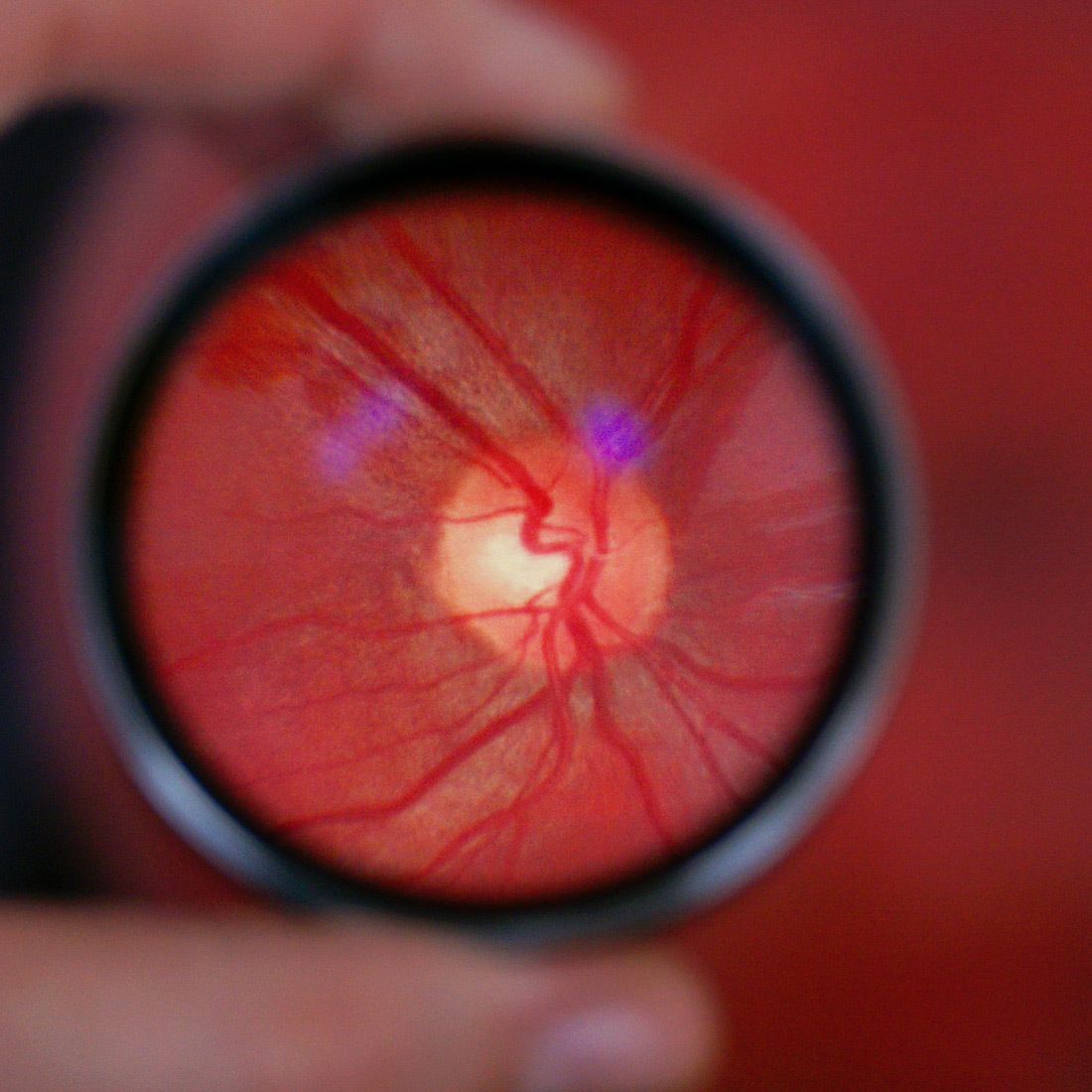 Vue agrandie de la rétine, révélant les vaisseaux sanguins et le disque optique, crucial pour l'étude de la santé oculaire.