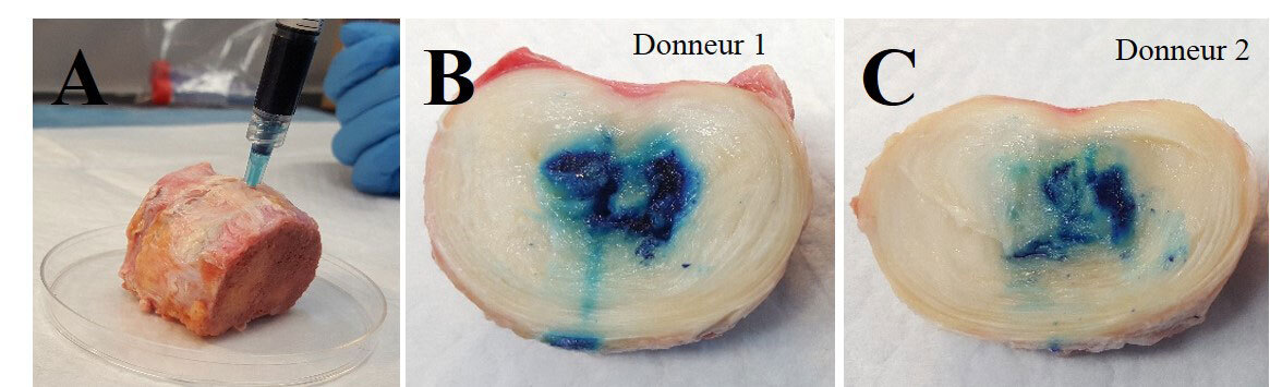 Injection d’hydrogel dans un noyau pulpeux humain