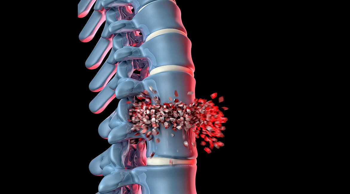 Modélisation 3D d'une hernie discale lombaire avec expulsion du nucleus pulposus.