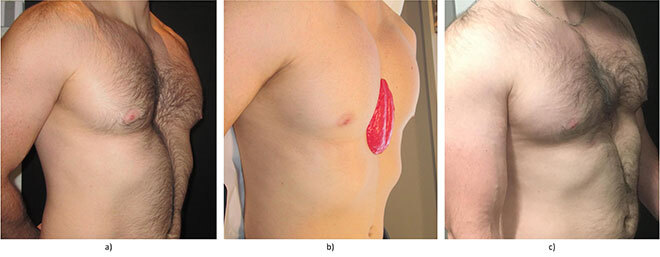 photo du patient avant et après implantation
