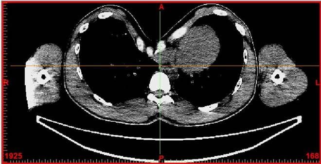 CT scan of rib cage, plexus excavatum