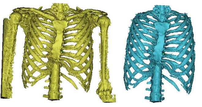 Rib cage image achieved through thresholding and after digital reconstruction