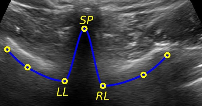 Anatomical landmarks of a vertebra