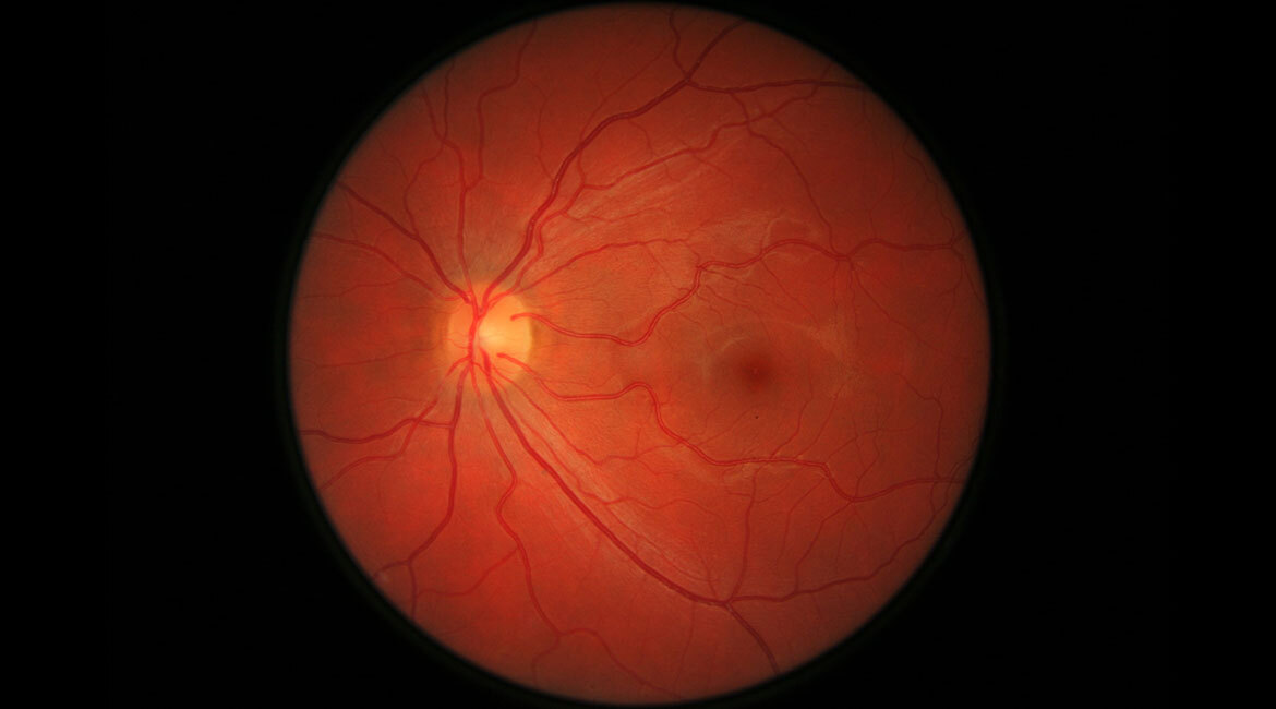 Eye retina