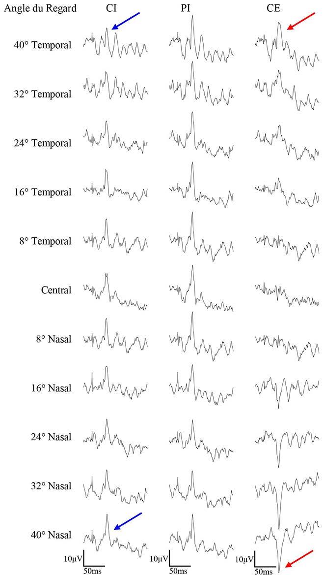signaux du l’ERG multiangulaire