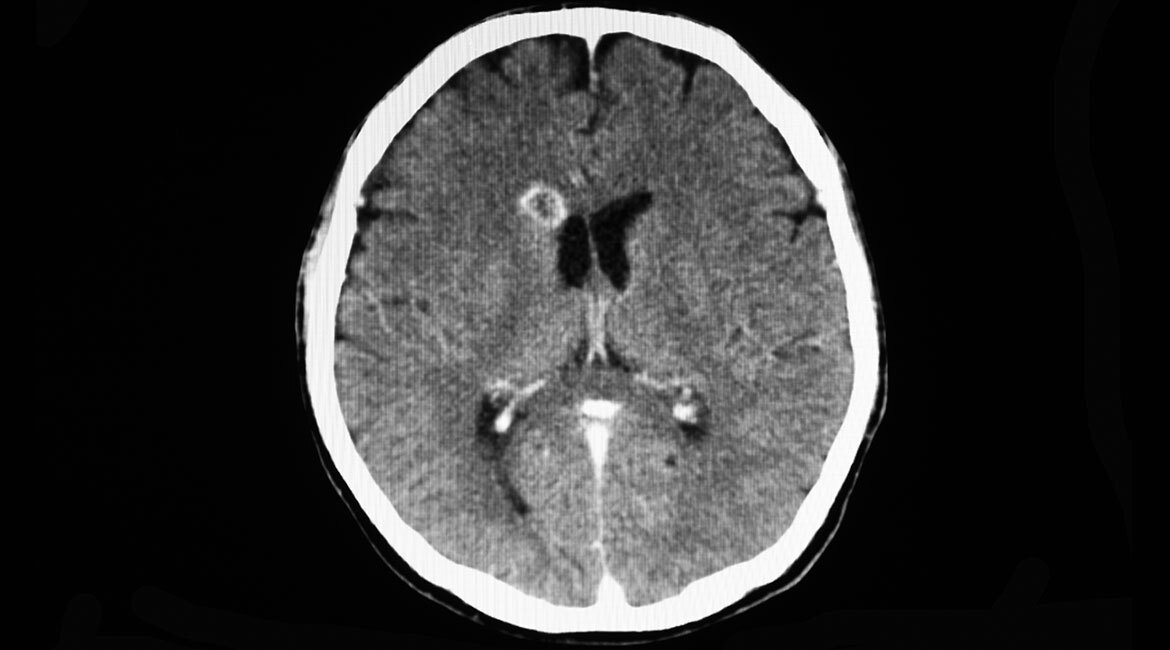 Image of a brain with a lesion